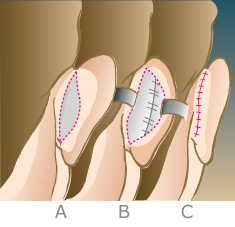 otoplastica